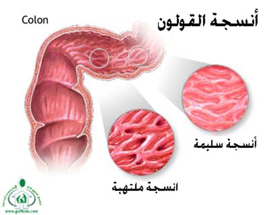 ���� Crohn`s Disease